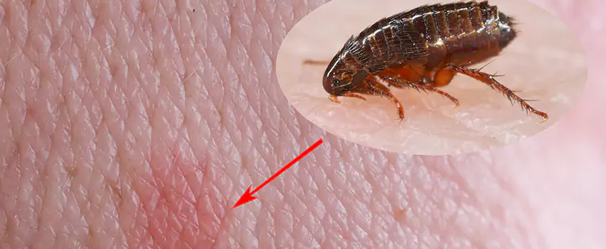 Flea Control for Humans Santa Monica, CA